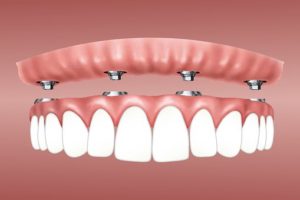 implant dentaire