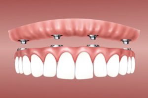 implants dentaires